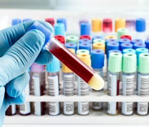 img-diagnosis-bl-1024x873-300x256 laboratory technician holding a blood tube test