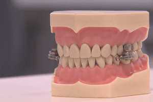 DentalSlim-Diet-Control-300x200 DentalSlim-Diet-Control